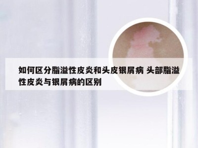 如何区分脂溢性皮炎和头皮银屑病 头部脂溢性皮炎与银屑病的区别