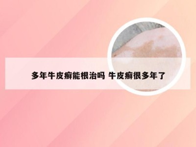 多年牛皮癣能根治吗 牛皮癣很多年了