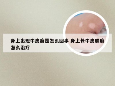 身上出现牛皮癣是怎么回事 身上长牛皮肤癣怎么治疗