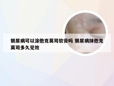 银屑病可以涂他克莫司软膏吗 银屑病抹他克莫司多久见效