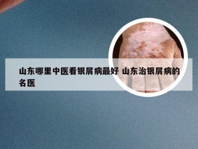 山东哪里中医看银屑病最好 山东治银屑病的名医