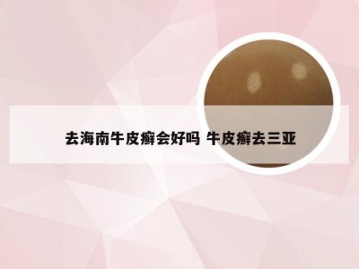 去海南牛皮癣会好吗 牛皮癣去三亚