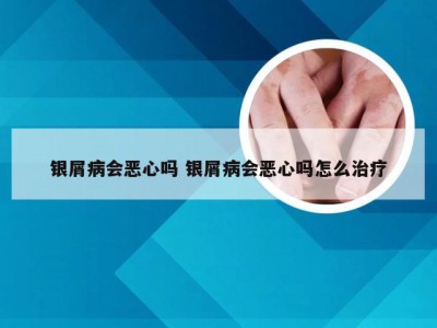 银屑病会恶心吗 银屑病会恶心吗怎么治疗