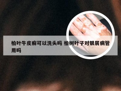 柏叶牛皮癣可以洗头吗 柏树叶子对银屑病管用吗