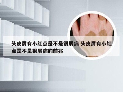 头皮屑有小红点是不是银屑病 头皮屑有小红点是不是银屑病的前兆