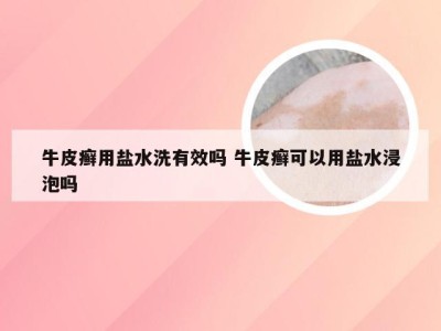 牛皮癣用盐水洗有效吗 牛皮癣可以用盐水浸泡吗
