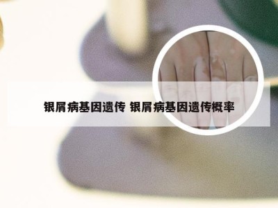 银屑病基因遗传 银屑病基因遗传概率