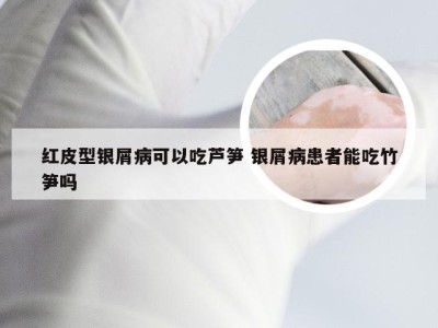 红皮型银屑病可以吃芦笋 银屑病患者能吃竹笋吗