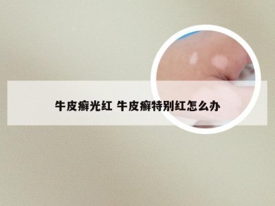 牛皮癣光红 牛皮癣特别红怎么办