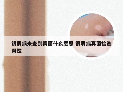 银屑病未查到真菌什么意思 银屑病真菌检测阴性