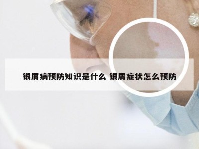 银屑病预防知识是什么 银屑症状怎么预防