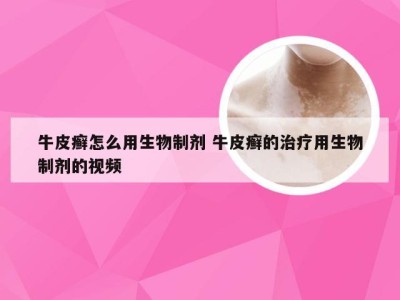 牛皮癣怎么用生物制剂 牛皮癣的治疗用生物制剂的视频