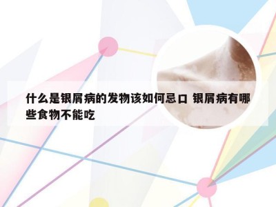 什么是银屑病的发物该如何忌口 银屑病有哪些食物不能吃