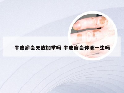 牛皮癣会无故加重吗 牛皮癣会伴随一生吗