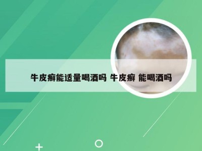 牛皮癣能适量喝酒吗 牛皮癣 能喝酒吗
