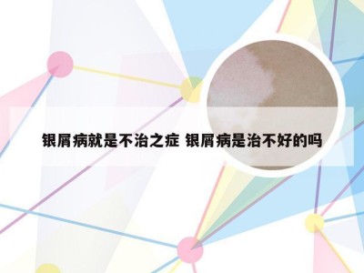 银屑病就是不治之症 银屑病是治不好的吗