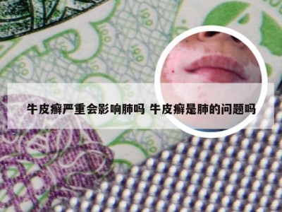 牛皮癣严重会影响肺吗 牛皮癣是肺的问题吗