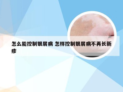 怎么能控制银屑病 怎样控制银屑病不再长新疹