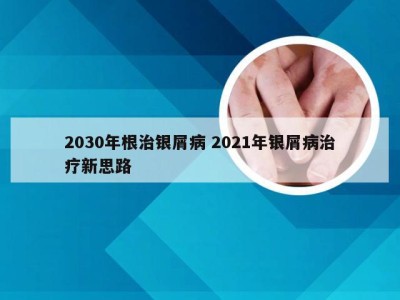 2030年根治银屑病 2021年银屑病治疗新思路