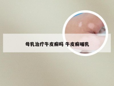 母乳治疗牛皮癣吗 牛皮癣哺乳