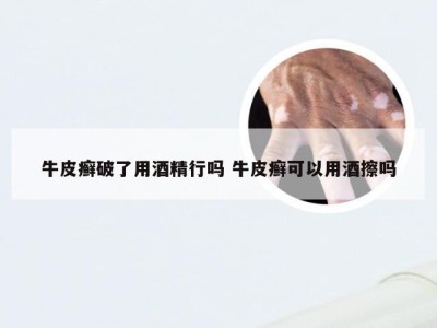 牛皮癣破了用酒精行吗 牛皮癣可以用酒擦吗