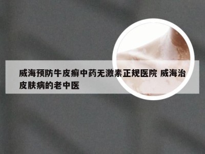 威海预防牛皮癣中药无激素正规医院 威海治皮肤病的老中医