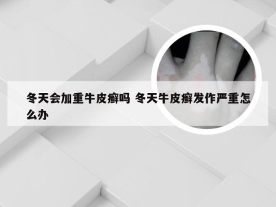 冬天会加重牛皮癣吗 冬天牛皮癣发作严重怎么办