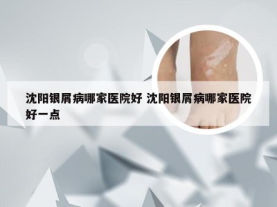 沈阳银屑病哪家医院好 沈阳银屑病哪家医院好一点