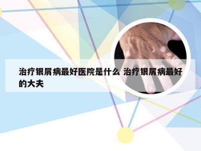 治疗银屑病最好医院是什么 治疗银屑病最好的大夫