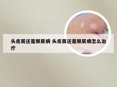 头皮屑还是银屑病 头皮屑还是银屑病怎么治疗