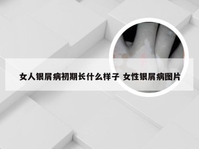女人银屑病初期长什么样子 女性银屑病图片