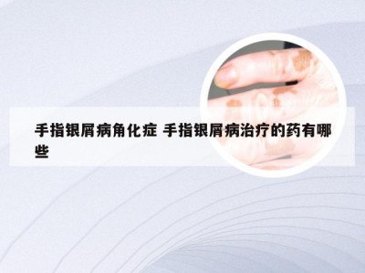 手指银屑病角化症 手指银屑病治疗的药有哪些