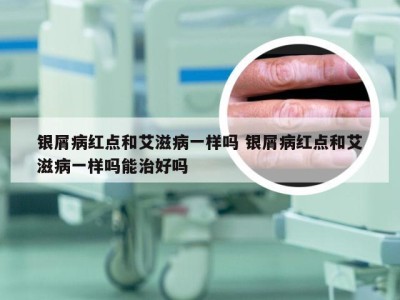 银屑病红点和艾滋病一样吗 银屑病红点和艾滋病一样吗能治好吗