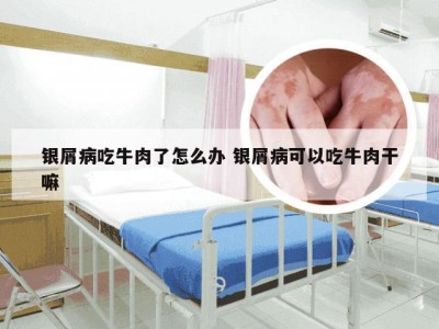 银屑病吃牛肉了怎么办 银屑病可以吃牛肉干嘛