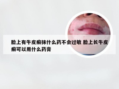 脸上有牛皮癣抹什么药不会过敏 脸上长牛皮癣可以用什么药膏