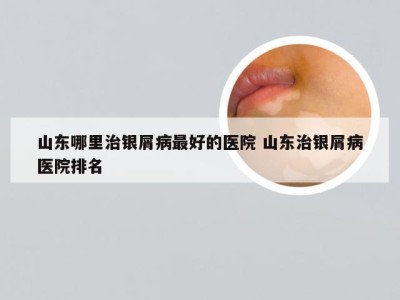 山东哪里治银屑病最好的医院 山东治银屑病医院排名