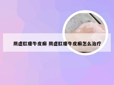 阴虚肛瘘牛皮癣 阴虚肛瘘牛皮癣怎么治疗