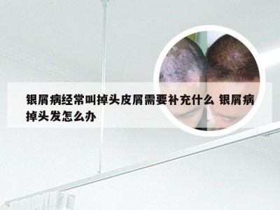 银屑病经常叫掉头皮屑需要补充什么 银屑病掉头发怎么办