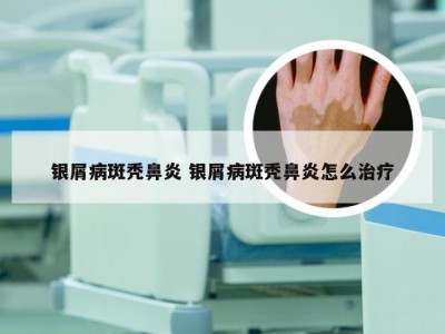 银屑病斑秃鼻炎 银屑病斑秃鼻炎怎么治疗