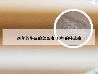 20年的牛皮癣怎么治 30年的牛皮癣