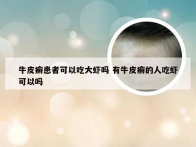 牛皮癣患者可以吃大虾吗 有牛皮癣的人吃虾可以吗