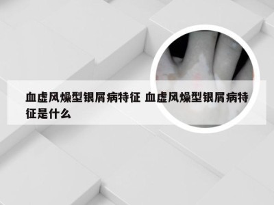 血虚风燥型银屑病特征 血虚风燥型银屑病特征是什么