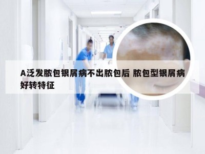 A泛发脓包银屑病不出脓包后 脓包型银屑病好转特征