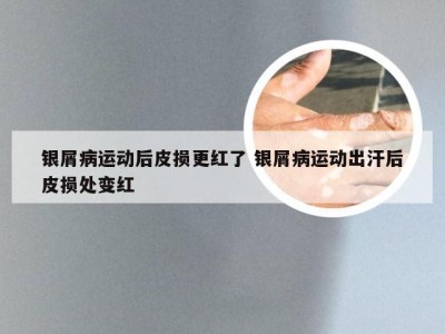 银屑病运动后皮损更红了 银屑病运动出汗后皮损处变红
