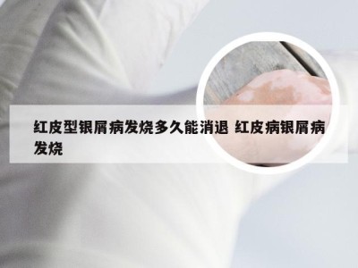 红皮型银屑病发烧多久能消退 红皮病银屑病发烧
