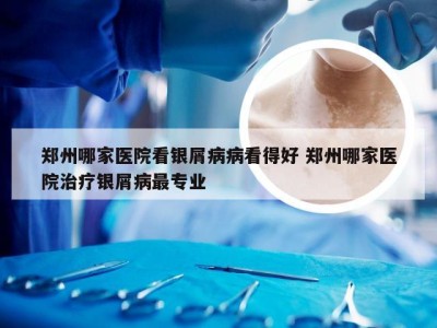 郑州哪家医院看银屑病病看得好 郑州哪家医院治疗银屑病最专业