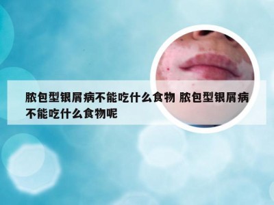 脓包型银屑病不能吃什么食物 脓包型银屑病不能吃什么食物呢