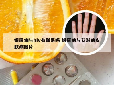 银屑病与hiv有联系吗 银屑病与艾滋病皮肤病图片