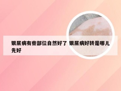 银屑病有些部位自然好了 银屑病好转是哪儿先好