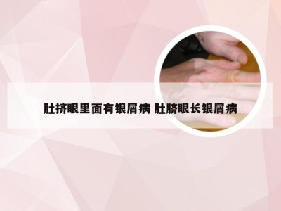 肚挤眼里面有银屑病 肚脐眼长银屑病